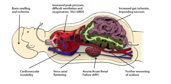  Multiple Organ Dysfunction Syndrome Flashcards